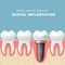 Dental implantation - row of teeth, gum with implant