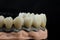 Dental implants on a black background