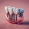 Dental implants,Modern dental implants,AI generated