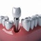 Dental implants surgery treatment, Dental crown 3D model close-up