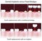 Dental implants versus fixed bridges