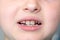 Dental medicine and healthcare. Little boy patient open mouth showing caries teeth decay