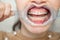 Dental mouth spreader, before teeth whitening