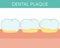 Dental plaque concept