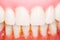 Dental Prosthesis Close Up