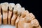 Dental prosthesis model with implanted teeth