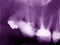 Dental x-ray film showing cured teeth