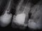 dental x-ray of several bad molars. caries