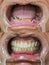 Dental repair - full dental bridge on dental implants