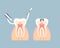 dental teeth care with tooth decay, cavity, caries, internal organs anatomy nervous system, periodontal