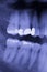 Dental teeth filling dentists xray scan