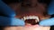 Dental and teethcare care concept. process of installing veneers. Veneers setting in modern dentistry. Close-up shot of