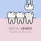 Dental Tooth Veneer Installation