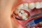 Dental treatment in dental clinic. Rotten carious tooth macro. T