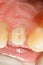 Dental treatment - occlusal view