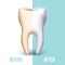Dental veneer, teeth whitening vector concept