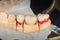 Dental veneers, ceramic and zirconium crowns of teeth close-up macro isolate on black background. Laboratory technical production