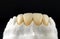 Dental veneers and crowns in the plaster model for treatment and new smile. Zirconia crowns with full porcelain. Dental Prosthetic