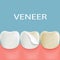 Dental veneers on a human tooth. Stock
