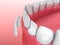 Dental Veneers: Porcelain Veneer installation Procedure