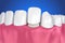 Dental Veneers: Porcelain Veneer installation Procedure.