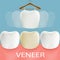 Dental veneers. Tooth anatomy.