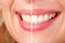 Dental Whitening