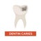 Dentin caries dental care tooth damage hole dentistry