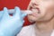 Dentist applies a tooth whitening gel with a syringe. girl with open mouth in doctor`s office.