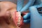 Dentist checking bracket at the braces on the female patient. Close-up. Real People.