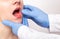 Dentist doctor examines the bite of the jaw of a girl and a bad tooth with pulpitis, gum disease, close-up, fluorosis