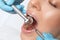 A dentist doctor treats caries on a tooth of a young beautiful woman in a dental clinic. Tooth filling