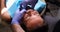 Dentist examines patient oral cavity and installs dental veneers closeup