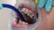 Dentist Examines Teeth With Braces