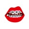 Dentist, orthodontist. Braces on your teeth.Open mouth.Dentition with braces, dental braces.Red lips.Vector illustration