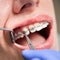Dentist placing braces on female patient teeth.