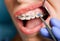 Dentist placing braces on female patient teeth.