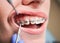 Dentist placing braces on female patient teeth.