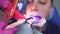 The dentist will fix the light filling using a photopolymer dental cordless lamp. The doctor shines ultraviolet light into the pat