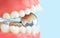 Dentistry conceptual photo. Close-up individual tooth tray Orthodontic dental theme. Close-Up Of Dentures Against Blue Background