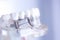 Dentsts dental tooth implant