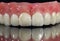 Denture, dental bridge