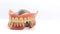 Denture resin and metal