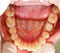 Denture Under Treatment