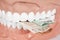 Dentures biting euro banknotes close up