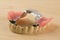 Dentures with metal-ceramic crowns