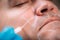 Dermal Fillers for Men. Facial Contouring Before Dermal Filler Treatment