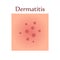 Dermatitis on human skin with itching, pain and rash
