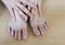 Dermatitis inflammation of toenails fungus, Ingrown toenail.