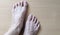 Dermatitis inflammation of toenails fungus, Ingrown toenail.